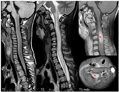 Acute Cervical Longitudinally Extensive Transverse Myelitis in a Child With Lipopolysaccharide-Responsive-Beige-Like-Anchor-Protein (LRBA) Deficiency: A New Complication of a Rare Disease